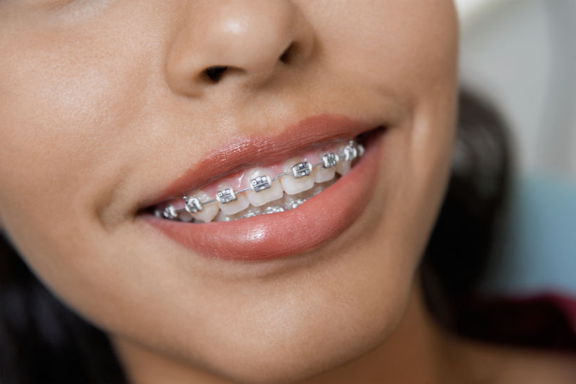 What to Consider When Buying Clear Braces